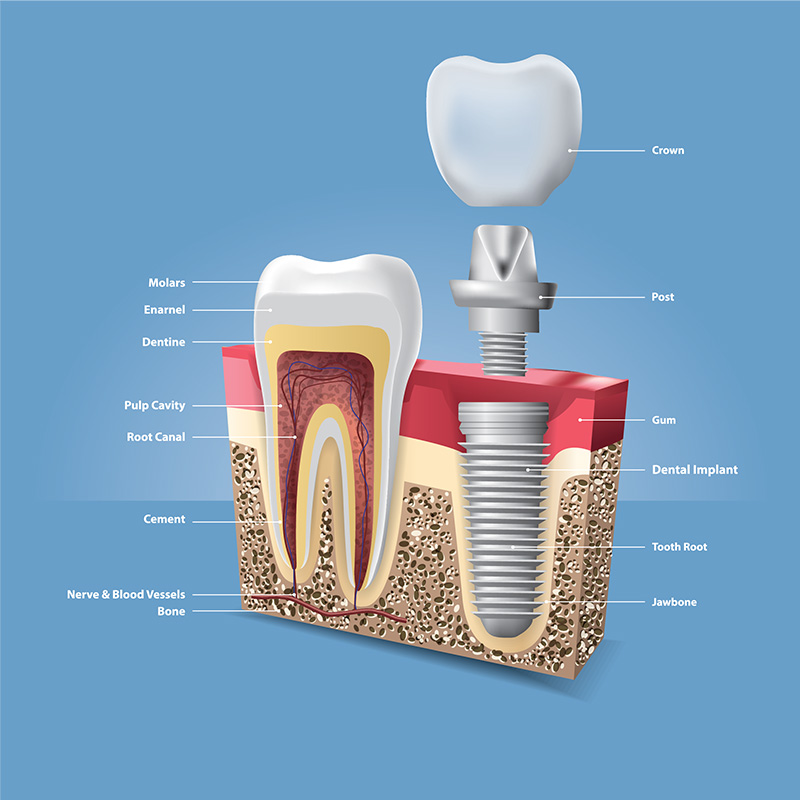 dental-implant-scheme - The Center For Dental Healing