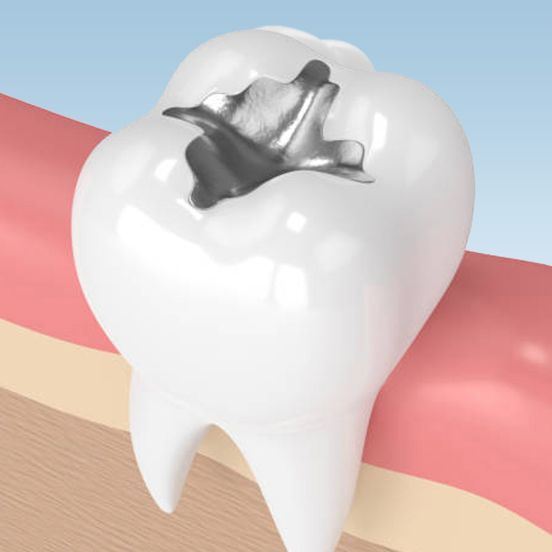 dental-metal-filling - The Center For Dental Healing