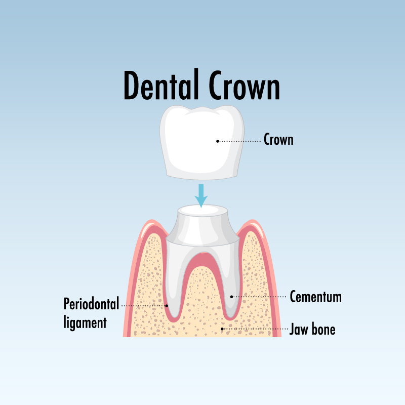 Dental_Crown - The Center For Dental Healing