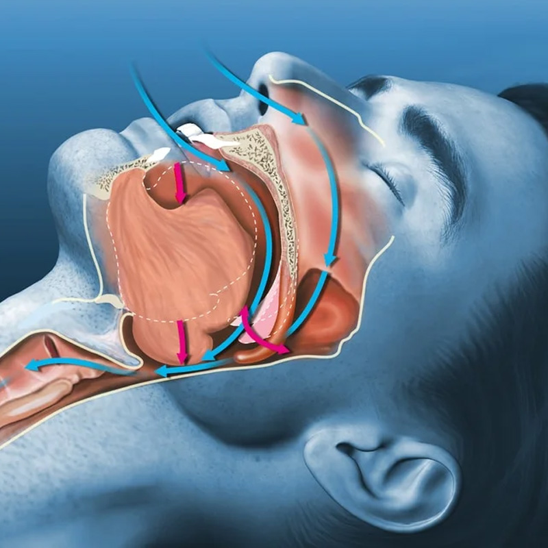 Sleep Apnea Appliance-2 - The Center For Dental Healing What Is a Sleep Apnea Appliance?