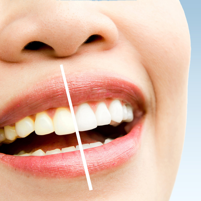 Whitening-3 - The Center For Dental Healing